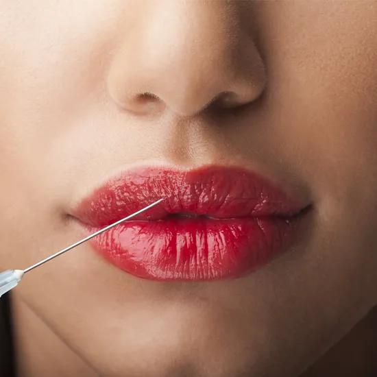 ácido hialurónico aumento de labios MH Centro Médico Estético